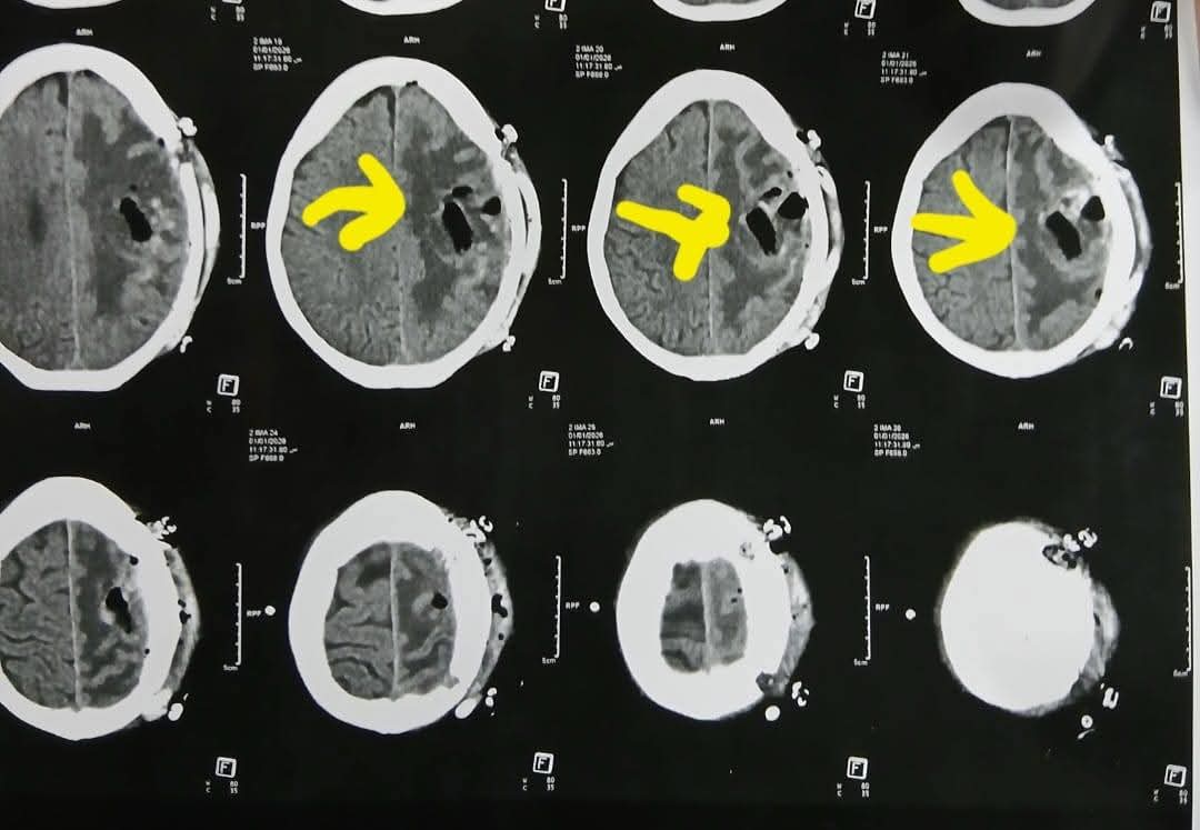 اشعة على المخ لمسنة