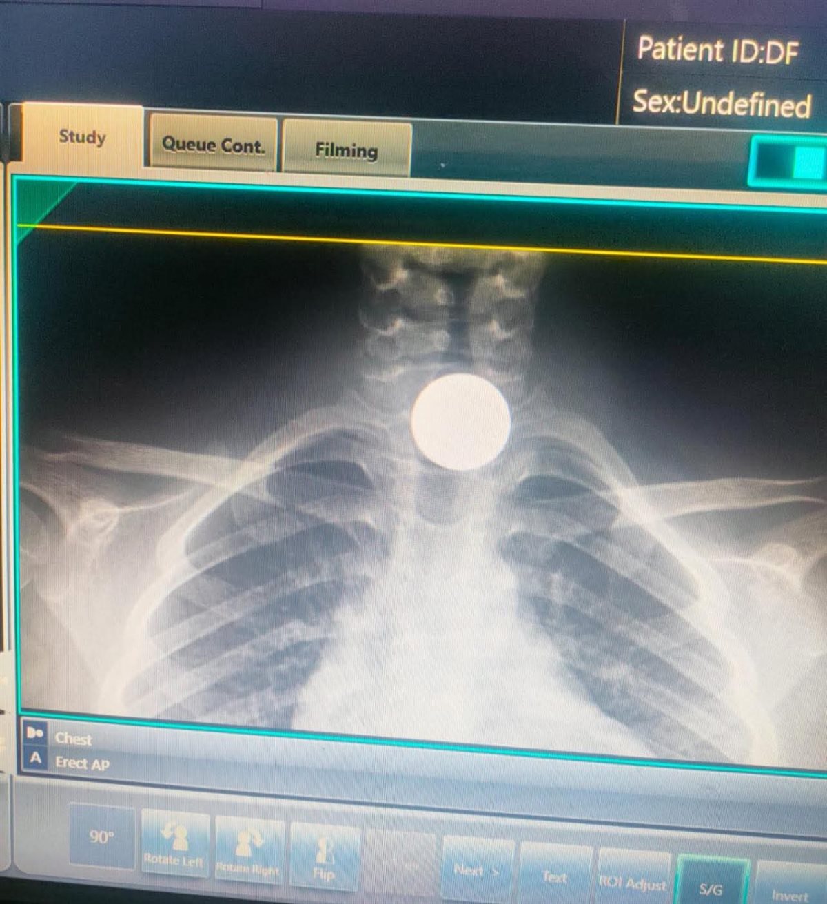 إنقاذ طفل ابتلع عملة معدنية ببورسعيد