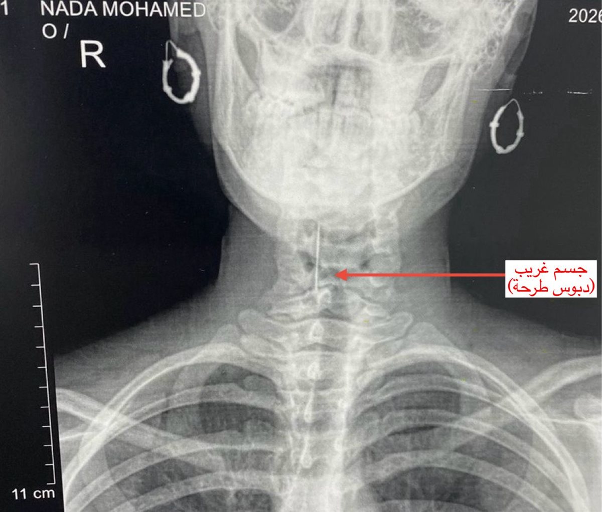 أشعة توضح مكان الدبوس