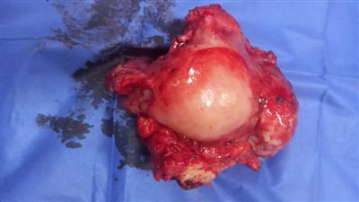 استئصال ورم خبيث يزن 20 كجم من رحم سيدة ستينية ببنى سويف