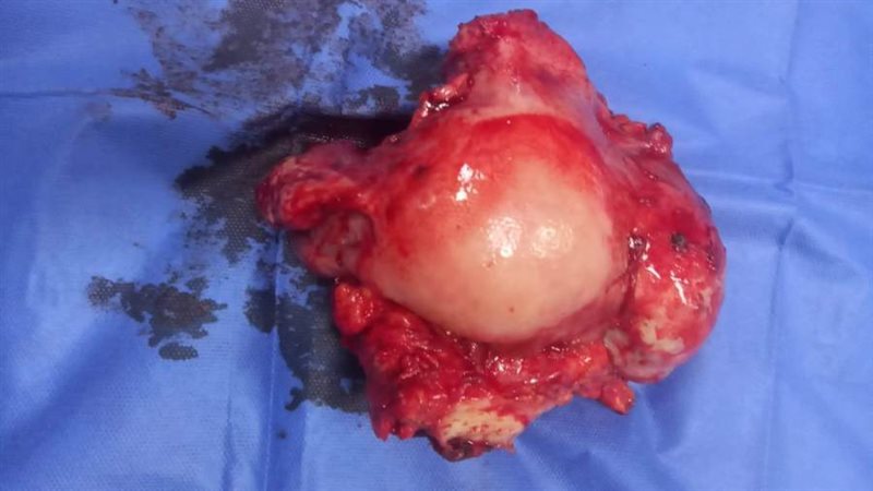 استئصال ورم سرطانى