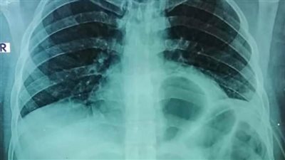 بنها الجامعي ينجح في إنقاذ حياة مريض تعرض لطعنة مطواة بالصدر