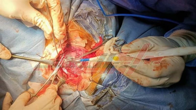 استئصال الأورم