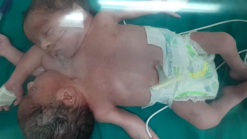 التوأم الملتصق