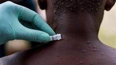  الصحة العالمية: نيجيريا بها 63% من إجمالي الإصابات بجدرى القرود 