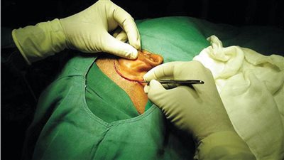 لأول مرة.. نجاح الأطباء في إجراء عملية بشق طبلة الأذن لطفل بالإسكندرية