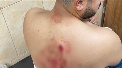 التعدي على مهندس بسبب سعر بوكيه ورد فى المنوفية وإصابته بـ 50 غرزة