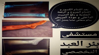 جراحة ناجحة تنقذ طرف وقدم طفل من البتر بشمال سيناء