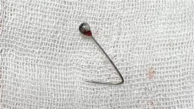 إنقاذ حياة فتاة ابتلعت 