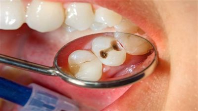 7 نصائح من وزارة الصحة للوقاية من مرض تسوس الأسنان 