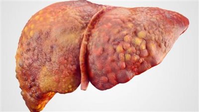 3 أسباب تؤدي إلى الإصابة بالتليف الكبدي 