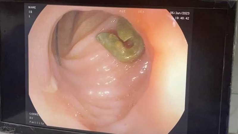 الدبوس داخل الأمعاء