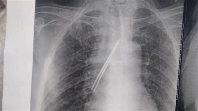 بنها الجامعي ينجح في إنقاذ حياة مريض باستخراج 