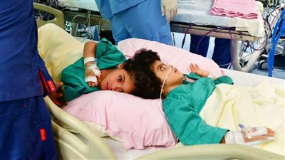 نجاح فصل التوأم السيامي 