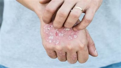 كيف تحمي نفسك من الإصابة بالأمراض الجلدية في فصل الصيف؟... الصحة تجيب