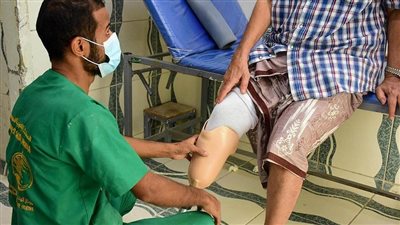 مركز الملك سلمان للإغاثة يدعم مركز الأطراف الصناعية في عدن وتعز 