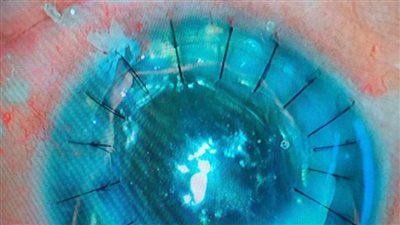  صحة المنيا.. زراعة قرنيتين لمريضين بمستشفى الرمد ضمن القضاء على قوائم الانتظار 