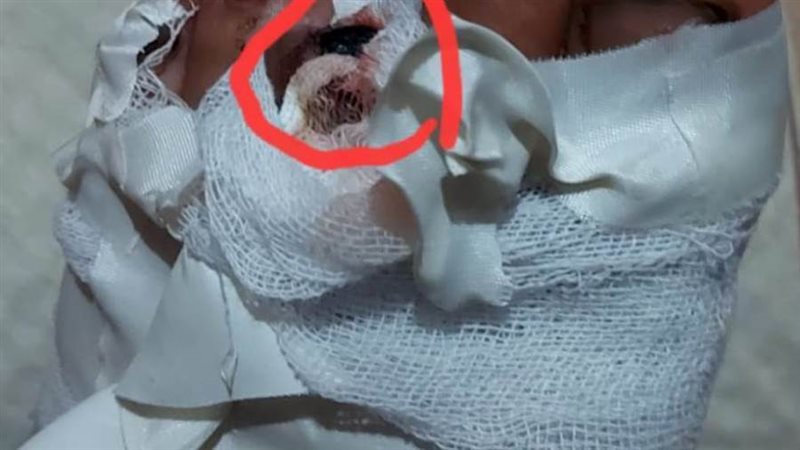 بتر اصبع قدم شاب