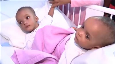 وصول التوءم السيامي النيجيري 