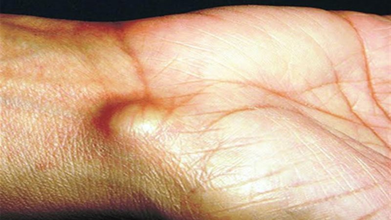 تعرف على الكيس الزلالي