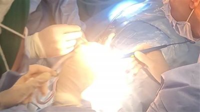 إجراء 17 عمليات زراعة قوقعة للأطفال بمستشفى الهلال للتأمين الصحي بسوهاج