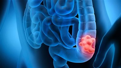 أبرز 4 نصائح للوقاية من سرطان القولون 