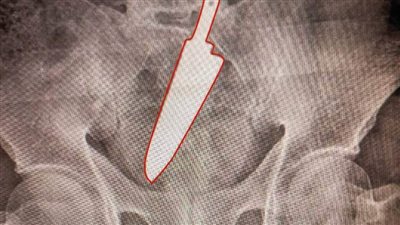 كان بيهرش.. تفاصيل استخراج سكين من معدة مريض بالدقهلية!!