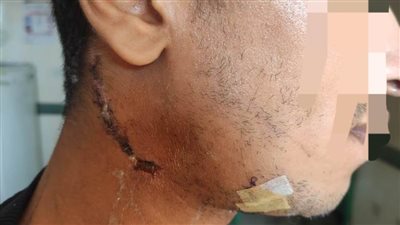 مستشفى سوهاج الجامعي ينجح في استخراج 