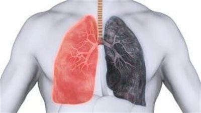 عاجل.. مرض الرئة الشائع والقاتل الذي لا يعرف أحد عنه شيئًا