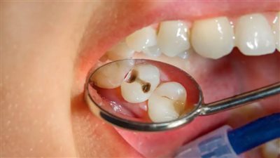 فعاليات توعوية حول تسوس الأسنان بمناسبة اليوم العالمي لصحة الفم والأسنان