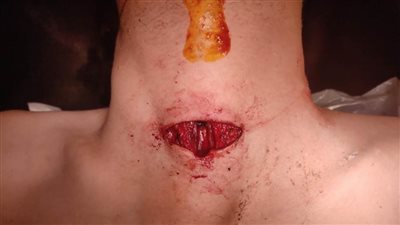 فريق طبي بمستشفي سوهاج الجامعي الجديد ينجح في إنقاذ شاب تعرض لعدة طعنات بالرقبة والظهر