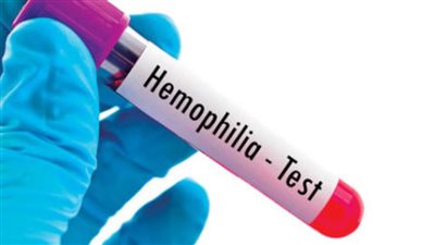 أهم 7 أعراض تشير إلى الإصابة بمرض الهيموفيليا الوراثي