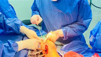 تركيب مسمار تليسكوبي لطفل مصاب بالعظام الزجاجية بمستشفى التأمين ببني سويف