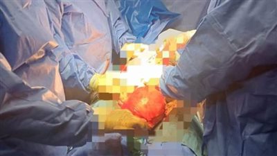 الفريق الطبي بمستشفى ادكو ينجح فى إنقاذ حياة مريضة باستئصال ورم ليفي يزن 8 كجم 