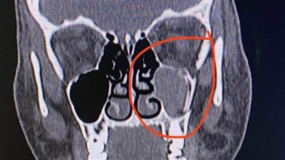 نجاح الفريق الطبي بمستشفى إدكو المركزي في إجراء عملية جراحية خطيرة لطفلة
