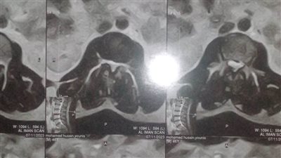 عم محمد يستغيث بالتضامن والتأمين الصحي اعاني من انزلاق الغضروف وأحتاج للعلاج