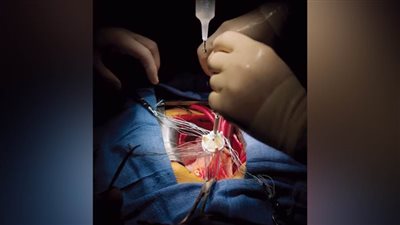 نجاح عملية استبدال أجزاء في الشريان الأورطي بصمام وأنبوب داكرون صناعى  