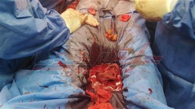 مستشفى برج البرلس تنقذ شابًا بعد خروج أمعائه بسبب اختراق آلة حادة لبطنه