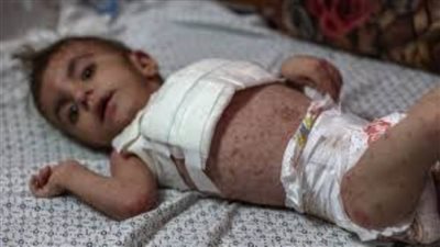 وسط أزمة إنسانية خانقة.. أطفال غزة يعانون من تفشي الأمراض الجلدية