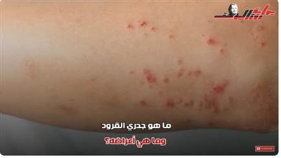 خوف وقلق بعد اعلان جدري القرود حالة طوارئ ..تعرف على طرق الوقاية