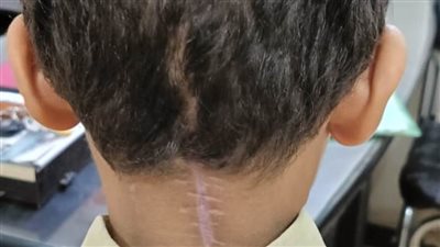 مستشفى سوهاج الجامعي ينجح في استئصال 