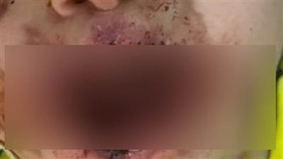 ثلاث فرق طبية بمستشفى سوهاج الجامعي تنجح في إعادة فتح فم طفل تعرض للدغات نحل