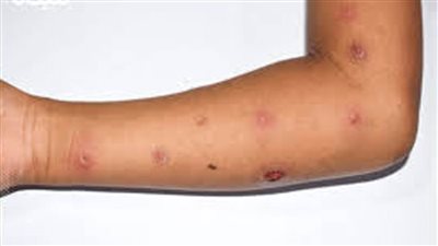 الجابون تعلن اكتشاف أول حالة إصابة بجدري القردة