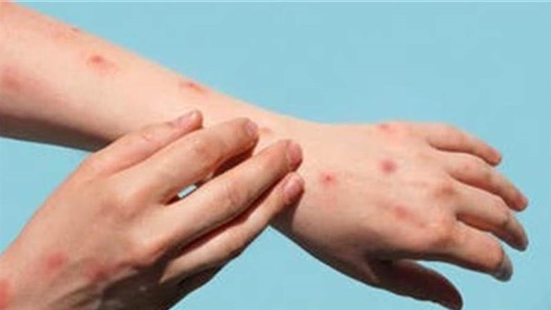 فيروس جدري القردة