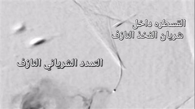 إنجاز طبي جديد لعلاج شرايين 