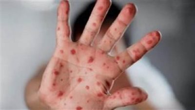 اكتشاف 4 حالات إصابة بجدري القردة في باكستان