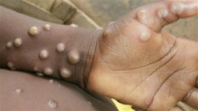 اليمن ينفي تسجيل أي إصابة بـ