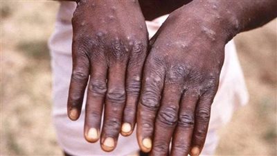 المركز الأفريقي للسيطرة على الأمراض يطلق خطة استجابة لوباء جدري‎ ‎القردة