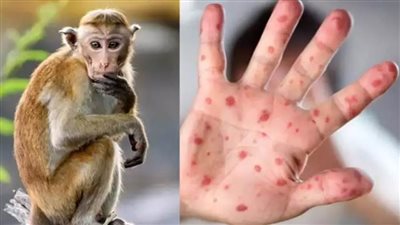 ارتفاع حصيلة إصابات جدري القرود في الفلبين إلى 14 حالة