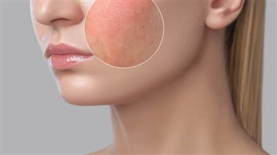 هل تعانين من المسامات المفتوحة في وجهك؟ تعرفي على طرق التخلص منها